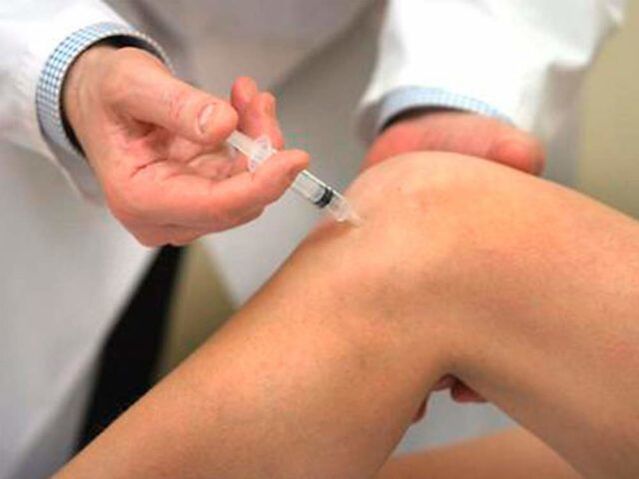 Intraartikularna injekcija je ena najnaprednejših oblik zdravljenja artroze kolenskega sklepa. 
