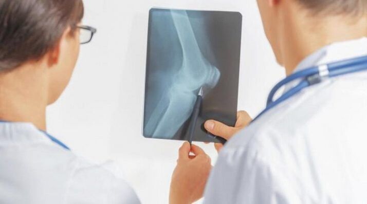 Po potrebni diagnozi artroze kolenskega sklepa zdravniki predpisujejo kompleksno zdravljenje