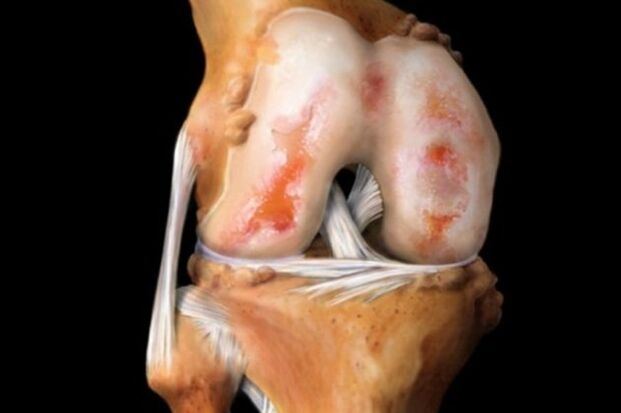 Uničenje kolenskega sklepa zaradi artroze - pogosta patologija mišično-skeletnega sistema