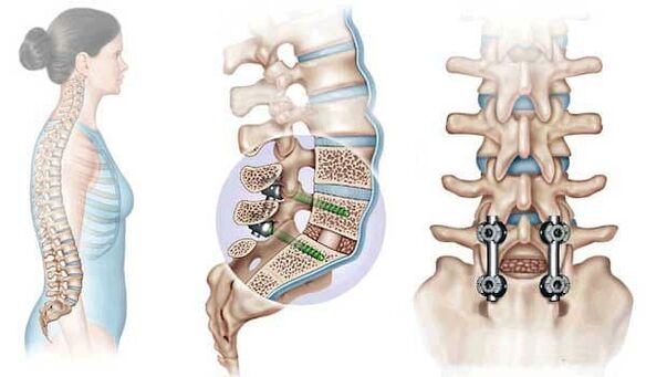 Fiksacija premaknjenih vretenc z vsadki v napredni fazi osteohondroze