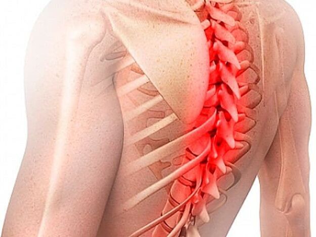 Osteohondroza torakalne hrbtenice je redka oblika bolezni