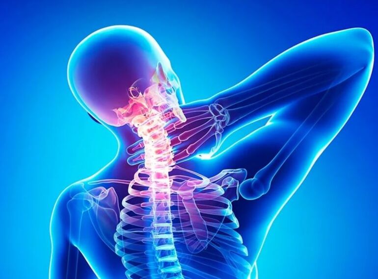 Osteohondroza vratne hrbtenice