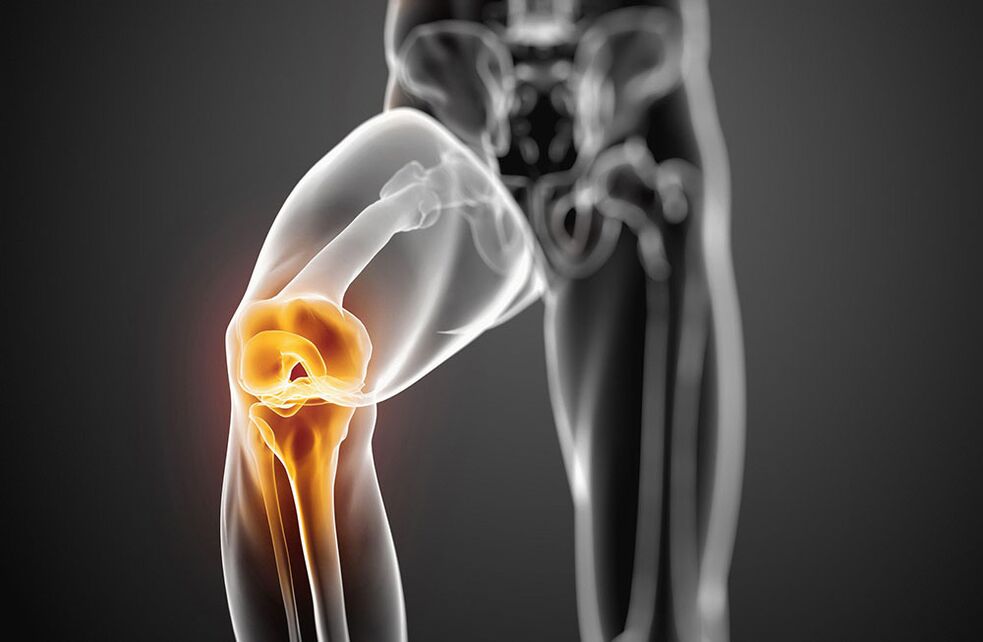 Arthroza kolenskega sklepa