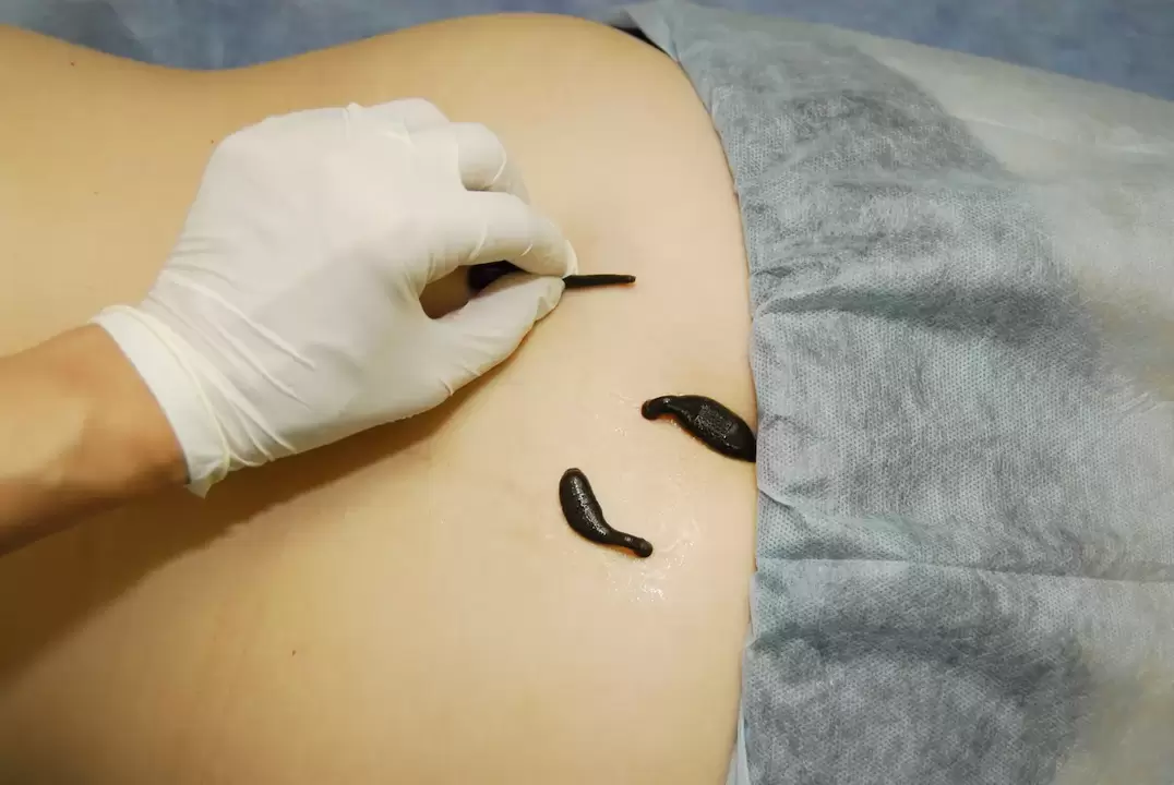 namestitev pijavk za ledveno osteohondrozo