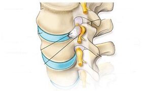 Glavni simptomi cervikalne osteohondroze