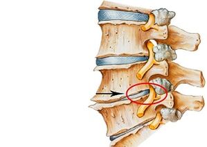 Vzroki za cervikalno osteohondrozo