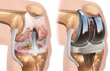 Endoprostetika kolenskega sklepa z gonartrozo