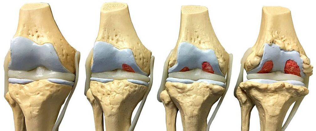 Stopnje artroze kolenskega sklepa